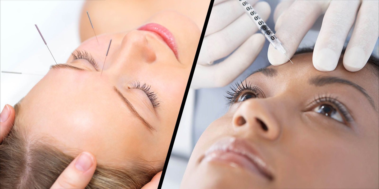 Facial Cosmetic Acupuncture: Benefits and How It Works : It is considered a natural botox